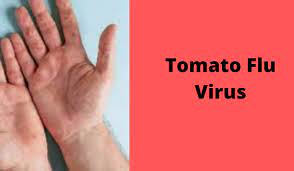 टोमैटो फ्लू के लक्षण, कारण और उपचार